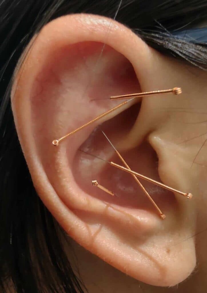 Acupuncture Sociale Sherbrooke gallery image 5