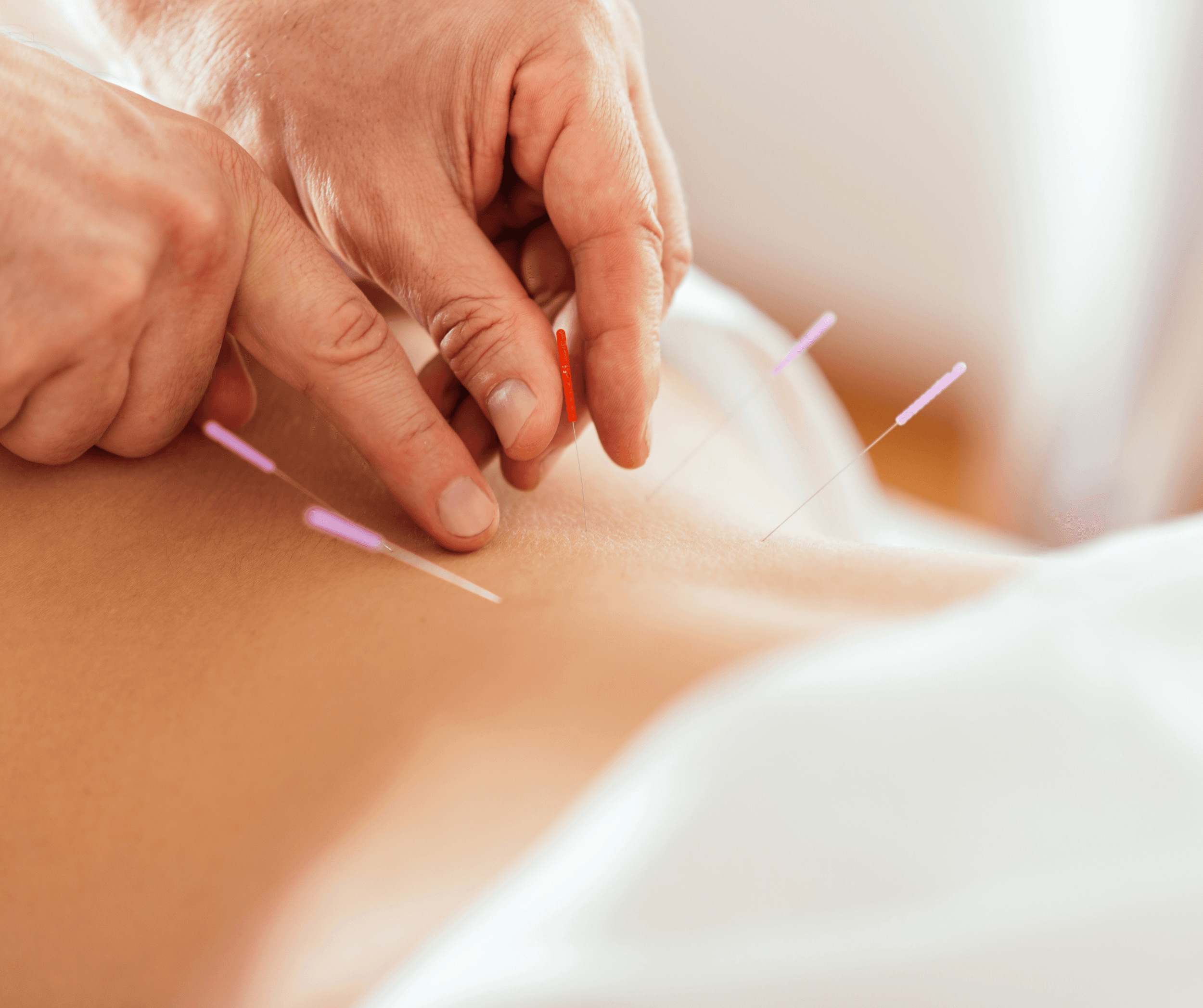 Peterborough West Acupuncture